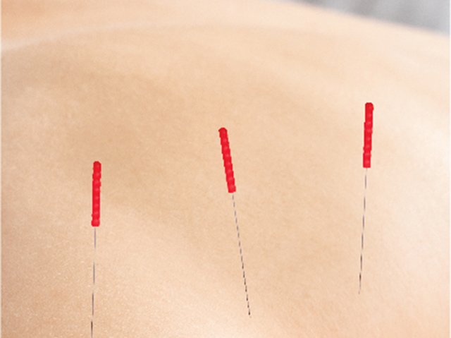 DRY NEEDLING